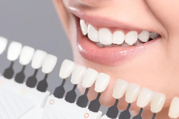 Clareamento Dental