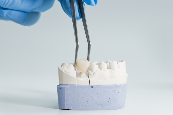 Prótese Dentária e Implante Dentário